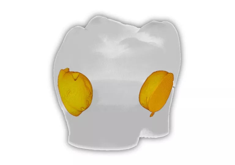 Ząb z wypełnieniami